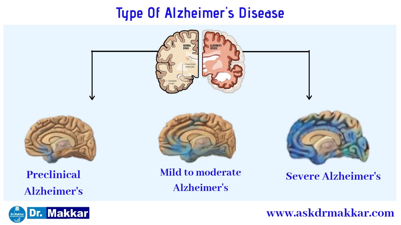 Alzheimer Homeopathic Treatment Dementia Loss Of Memory
